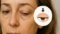 Ptose Palpebral: Queda da Pálpebra Superior